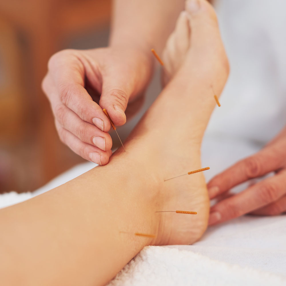 Acupuncture